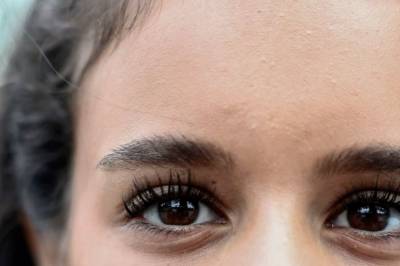 Marianne (19) truffet av laser: Dette ser hun nå
