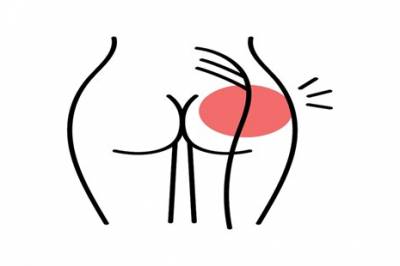 Isjias som følge av endometriose