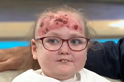 «Sommerfuglhud»: Jasmines (14) smertefulle hverdag