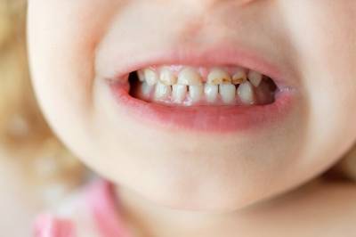 - Dette er den vanligste grunnen til hull i tennene hos barn