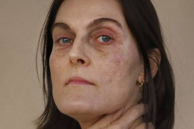 Rikke har alltid fått høre at hun ser så trøtt ut. I voksen alder fant hun årsaken