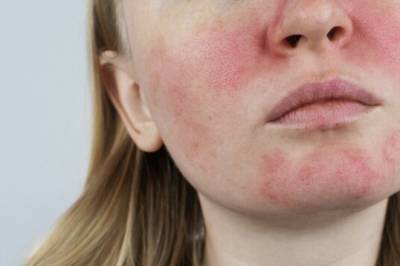 Advarer de som har rosacea: - Disse kremene forverrer huden