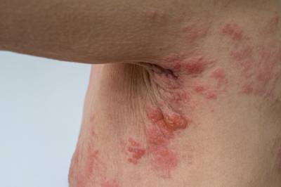 Politisk uenighet om helvetesildvaksinen: – Smerten var grusom